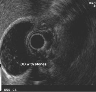 Fig. 34.1, Endoscopic ultrasonographic image of a gallbladder (GB) filled with gallstones.