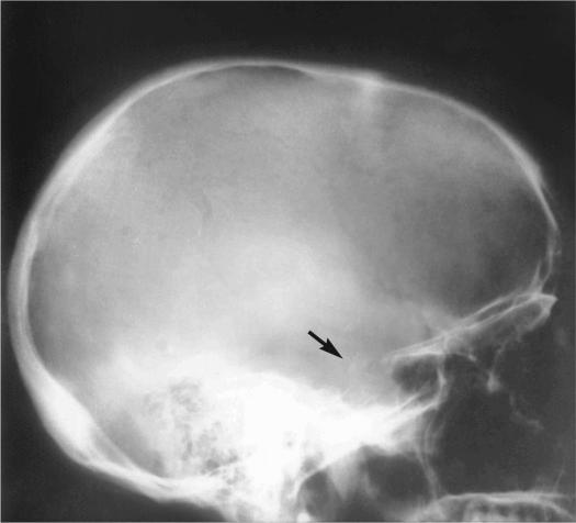 FIGURE 18-14, Intracranial chordoma: radiographic features.