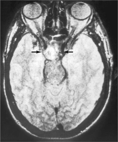 FIGURE 18-15, Chordoma: radiographic features.