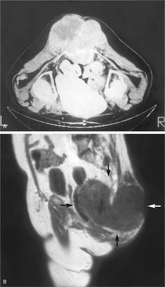 FIGURE 18-16, Sacrococcygeal chordoma: radiographic features.