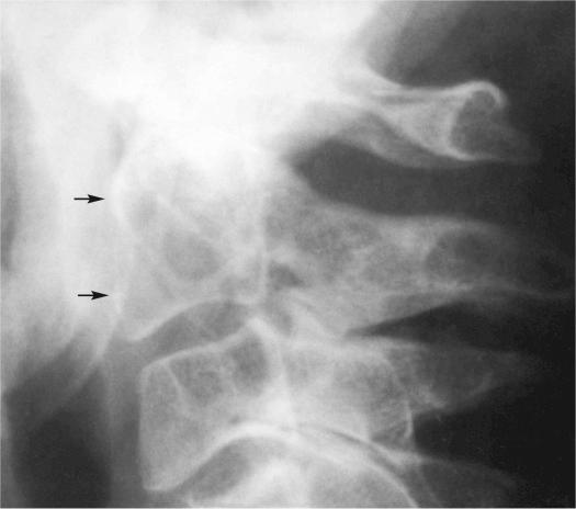 FIGURE 18-17, Chordoma of cervical spine: radiographic features.