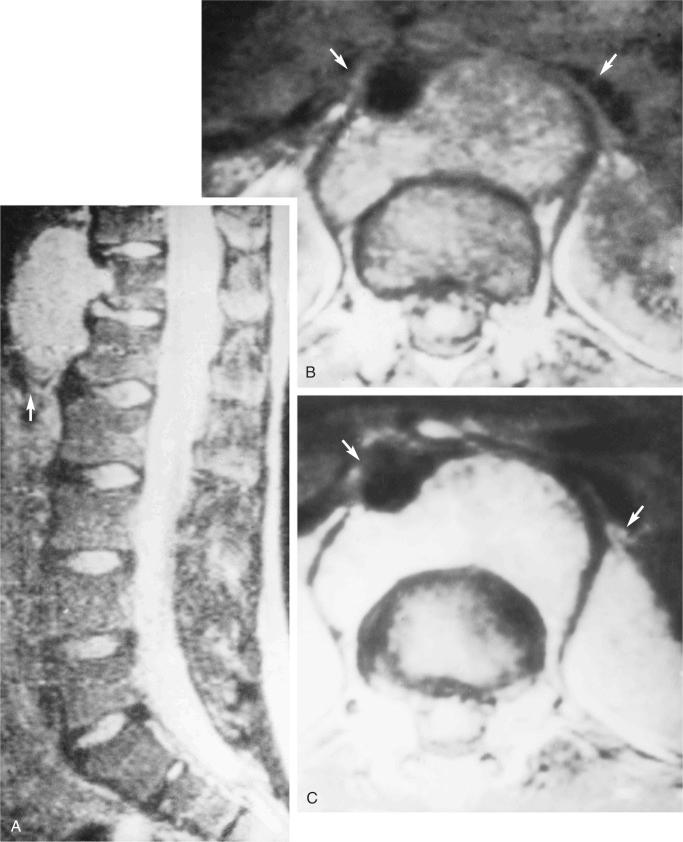 FIGURE 18-19, Vertebral chordoma: radiographic features.