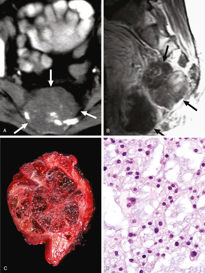 FIGURE 18-20, Chordoma: radiographic, gross, and microscopic features.