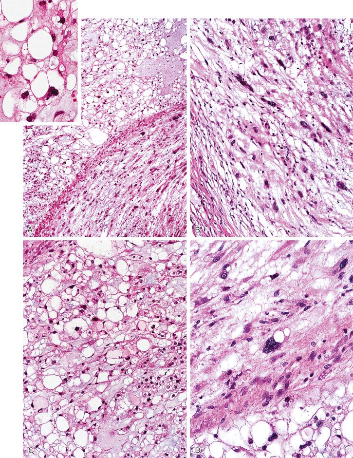 FIGURE 18-23, Chordoma: microscopic features.