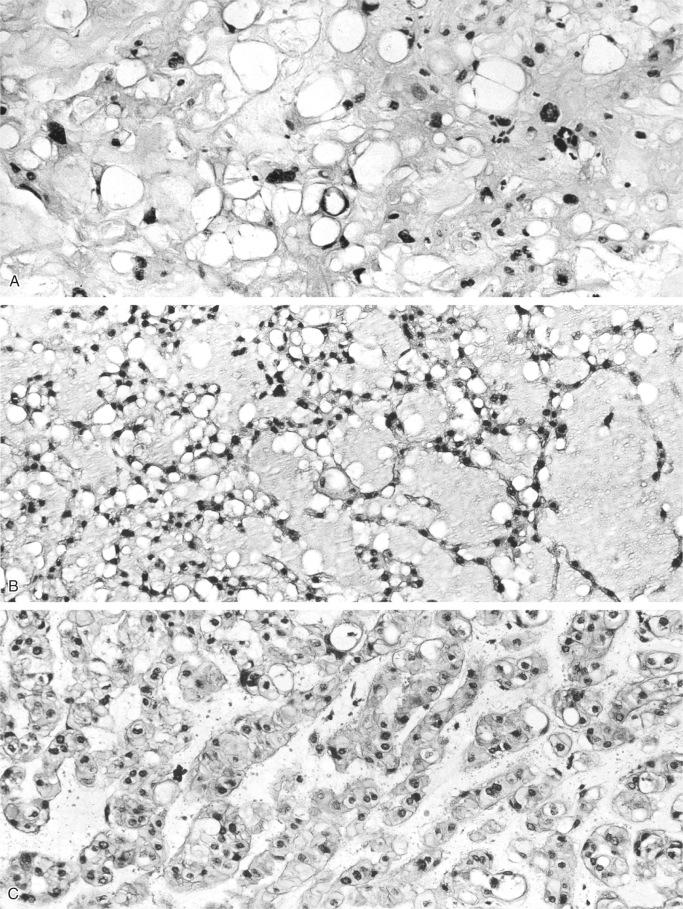 FIGURE 18-25, Chordoma: microscopic features.