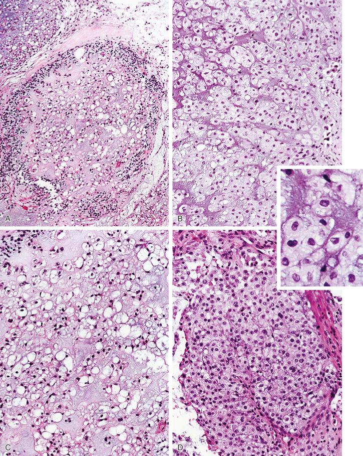 Chordoma And Related Lesions Clinical Tree 5317