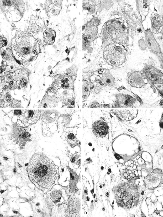 FIGURE 18-29, Chordoma: physaliphorous cells.