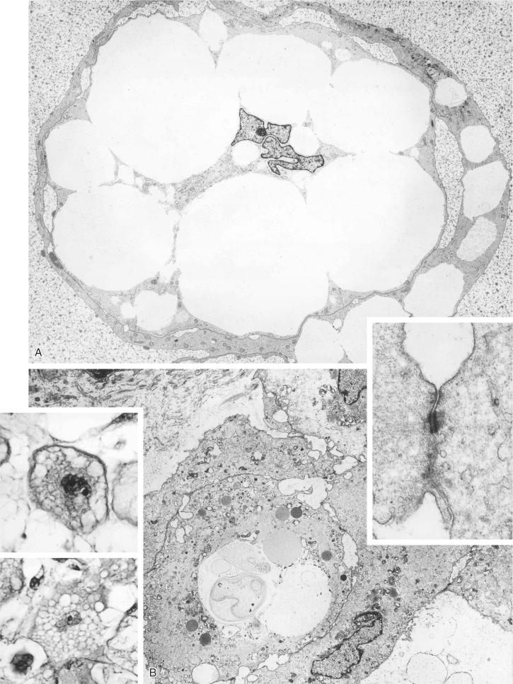 FIGURE 18-30, Chordoma: ultrastructural features.