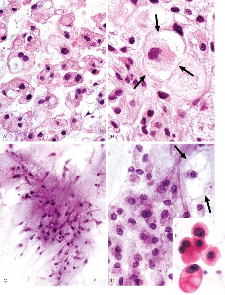 FIGURE 18-31, Chordoma: histologic and cytologic features.