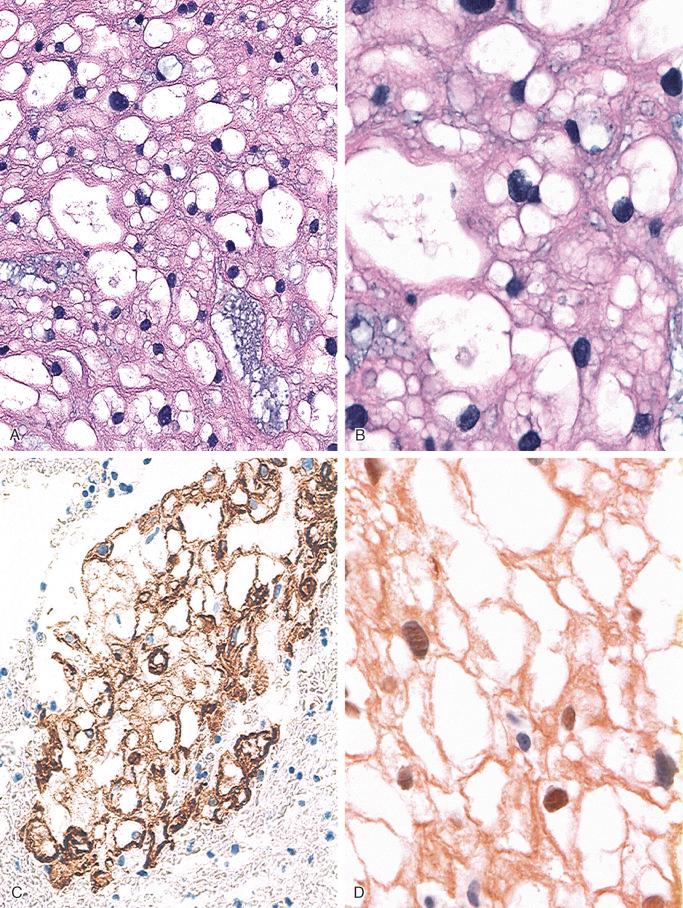 FIGURE 18-8, Notochord rest: microscopic and immunohistochemical features.