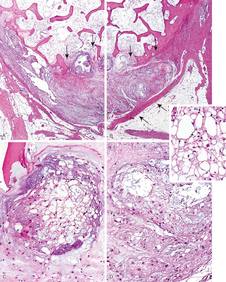 FIGURE 18-9, Chordoma developing in association with giant notochord rest: microscopic features.