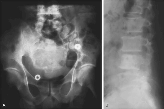 FIGURE 18-13, Chordoma: radiographic features.