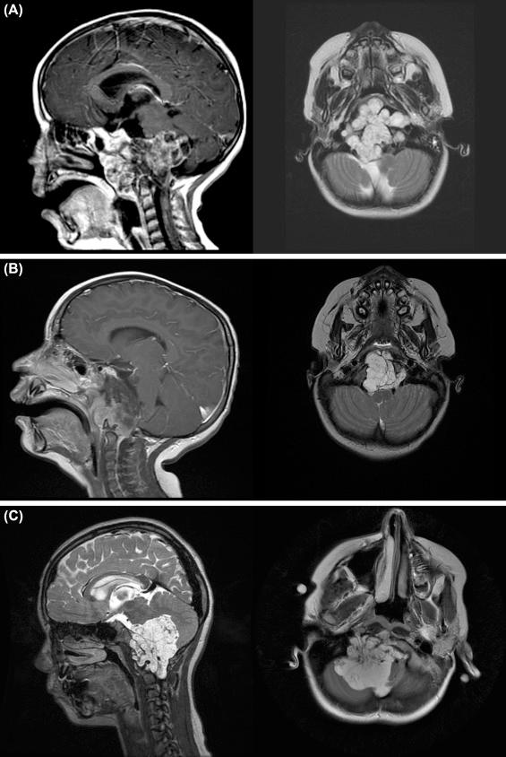 Figure 36.1, (A) Sagittal T1-weighted and axial T2-weighted images of a 3-year-old boy who presented with drooling. (B) Sagittal T1-weighted and axial T2 images of a 5-year-old boy who underwent tonsil and adenoidectomy for snoring and was found to have a retropharyngeal mass that was biopsied. (C) Sagittal and axial T2-weighted images of a 9-year-old girl who presented with right hypoglossal nerve palsy.