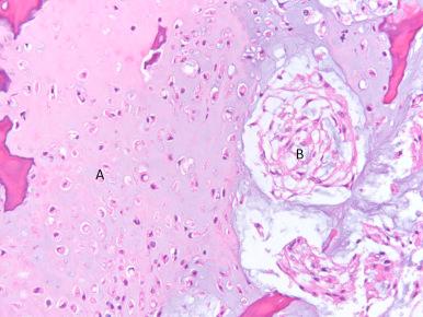 Figure 39.1, Chondroid chordoma. (A) Cartilage-like region of tumor and (B) chordoma cells.