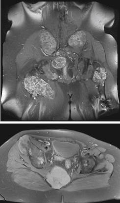 Figure 39.2, HMOCE patient with sacral chordoma. MRI with coronal and axial views.