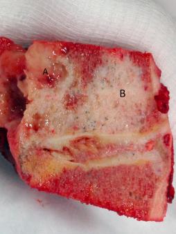 Figure 39.3, Chordoma in the mobile spine (A) with adjacent benign notochordal cell tumor (B).