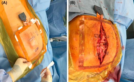 Figure 39.4, Spine mask for intraoperative navigation. (A) Prepping and laying down the mask and (B) incision open with mask in place. Electrodes on perimeter of mask act as reference fiducials.