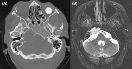 Figure 14.1, Chordoma. (A) CT angiogram demonstrates lytic lesion of the right petrous apex with nonsclerotic margins. Note anterolateral displacement of right internal carotid artery in the carotid canal. (B) Axial T2-weighted MRI demonstrates a markedly hyperintense lesion with soft tissue component extending into the prepontine cistern.