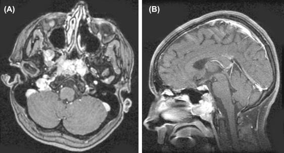 Figure 14.2, Clival chordoma. (A) Axial and (B) sagittal postcontrast T1-weighted MRIs with fat suppression demonstrate an intensely enhancing mass centered at the clivus. Soft tissue component extends into the nasopharynx.