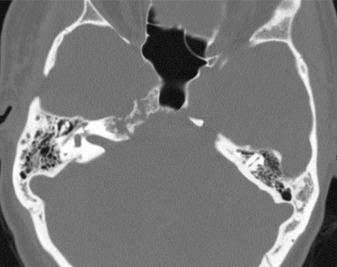 Figure 14.3, Chondrosarcoma. Axial CT shows a lytic lesion with calcifications within and sharp, nonsclerotic margins involving the right petrous apex.