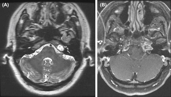 Figure 14.4, Chondrosarcoma of the left petroclival synchondrosis. (A) Axial T2-weighted and (B) postcontrast axial T1 fat suppressed images. Lesion is markedly hyperintense on T2 with punctate hypointense foci reflecting calcifications. Note heterogeneous enhancement.