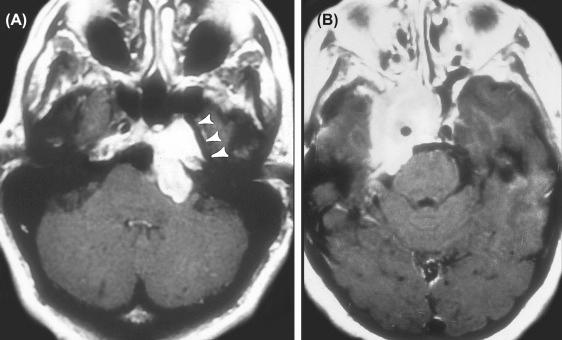 Figure 14.5, T1-weighted contrast-enhanced MRIs. (A) Chordoma displacing the petrous carotid laterally. (B) Parasellar meningioma encasing the internal carotid artery.