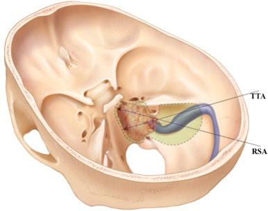 Figure 18.1, Schematic drawing showing petroclival exposure following retrosigmoid approach (RSA).