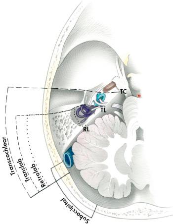 Figure 17.3, Axial diagram of the extent of bone removal involved in retrolabyrinthine, translabyrinthine, and transcochlear craniotomies.