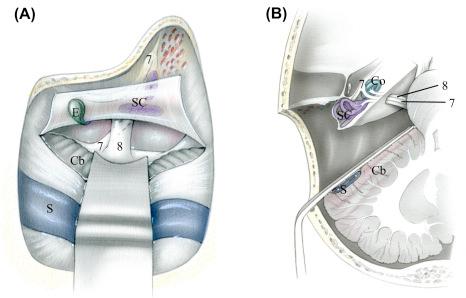 Figure 17.4, (A) Exposure with retrolabyrinthine approach with care to preserve bony labyrinth, facial nerve, and the endolymphatic sac (E) and duct with the dural opening. This approach alone gives insufficient exposure. It is usually used in combination with a subtemporal tentorial splitting approach. (B) Axial view of the retrolabyrinthine approach. 7 , seventh cranial nerve; 8 , eighth cranial nerve; Cb , cerebellum; Co , cochlea; S , sigmoid sinus; SC , semicircular canals.