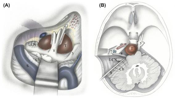 Figure 17.5, (A) Exposure of a clival tumor (T) via the translabyrinthine approach. (B) Axial view of the translabyrinthine approach to a clival tumor. ( S , sigmoid sinus; Cb , cerebellum; 5 , fifth cranial nerve; 7 , seventh cranial nerve; 8 , eighth cranial nerve; LCN , lower cranial nerves 9–11).