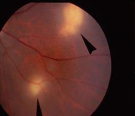 Figure 3.4, Fundus picture of the left eye of a patient with tuberculosis. Two whitish nodules corresponding to choroidal tubercles (arrowhead) are shown; the smallest one is below the inferior temporal artery.