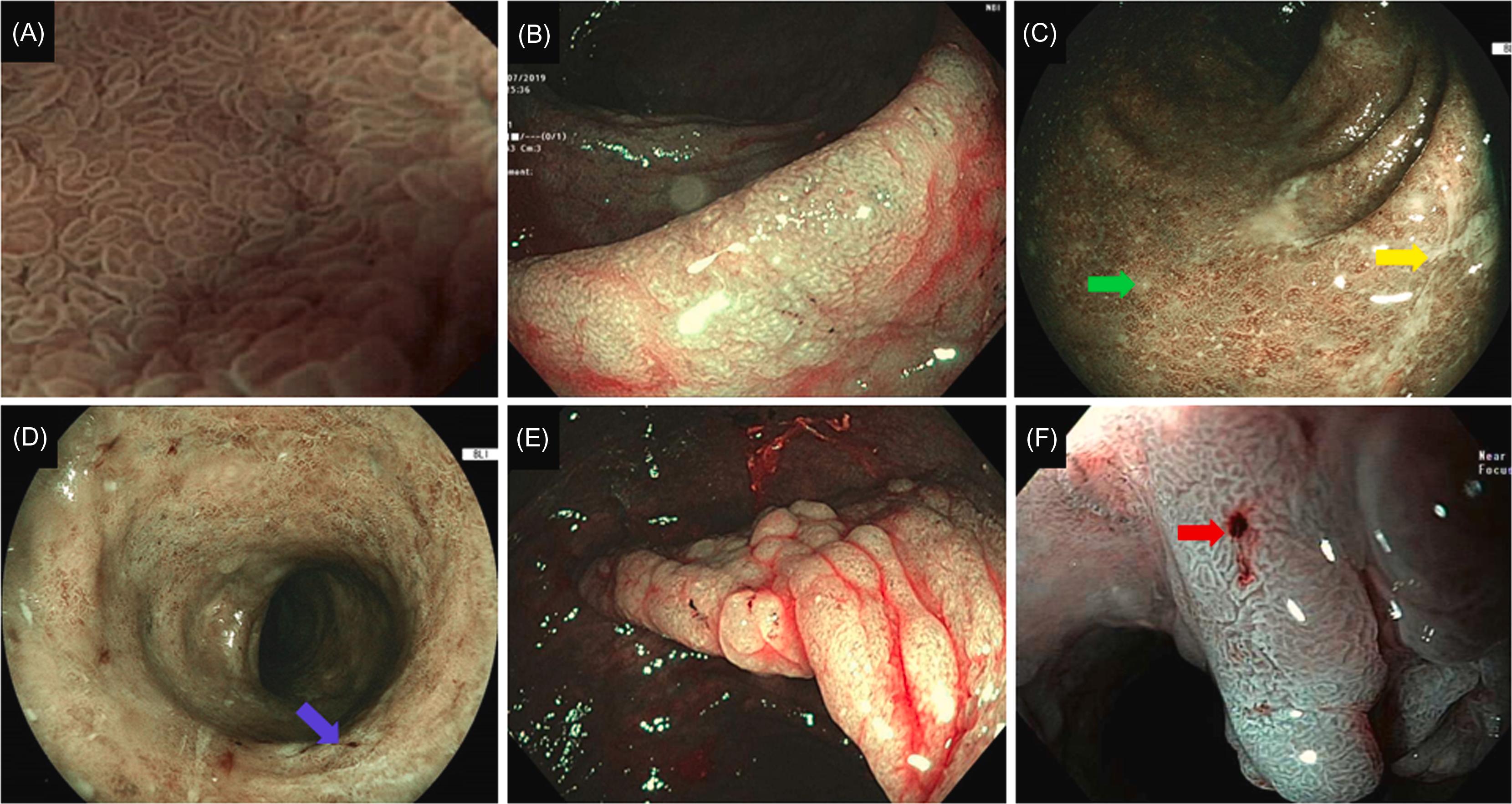 Figure 19.1, PICaSSO-mucosal architecture on narrow-band imaging or blue-light imaging: (A) Normal, (B and C) microerosions ( green arrow ), ulcers ( yellow arrow ), (D) mucosal scars ( blue arrow ), (E) mucosal edema, and (F) bleeding ( red arrow ). PICaSSO , The Paddington International Virtual Chromoendoscopy.