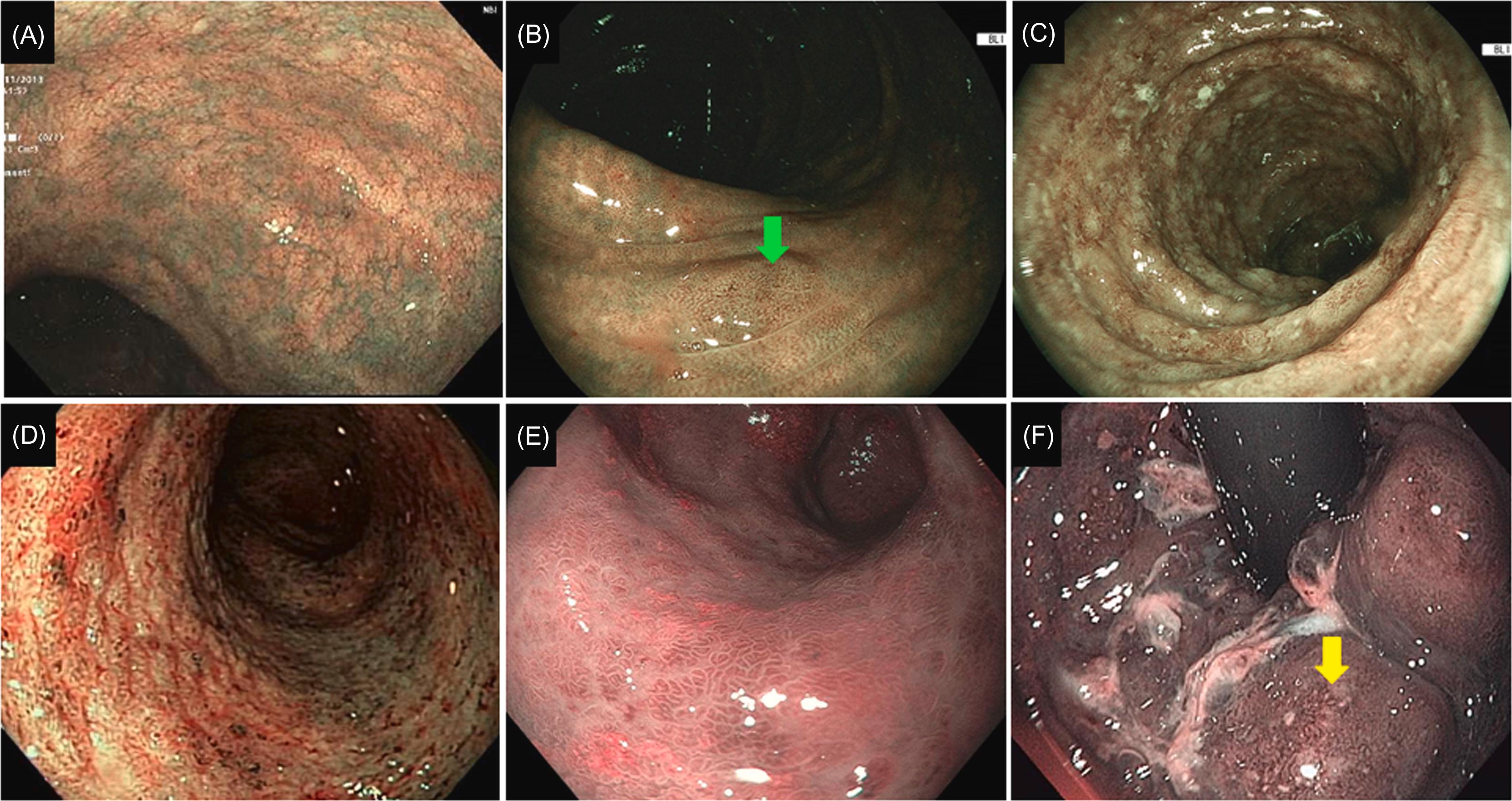 Figure 19.2, PICaSSO-vascular architecture on narrow-band imaging or blue-light imaging: (A) Normal subepithelial vascular network, (B) mildly dilated subepithelial vessels ( green arrow ), (C–E) crowded epithelial blood vessels, and (F) edema with crowed subepithelial blood vessels ( blue arrow ). PICaSSO , The Paddington International Virtual Chromoendoscopy.