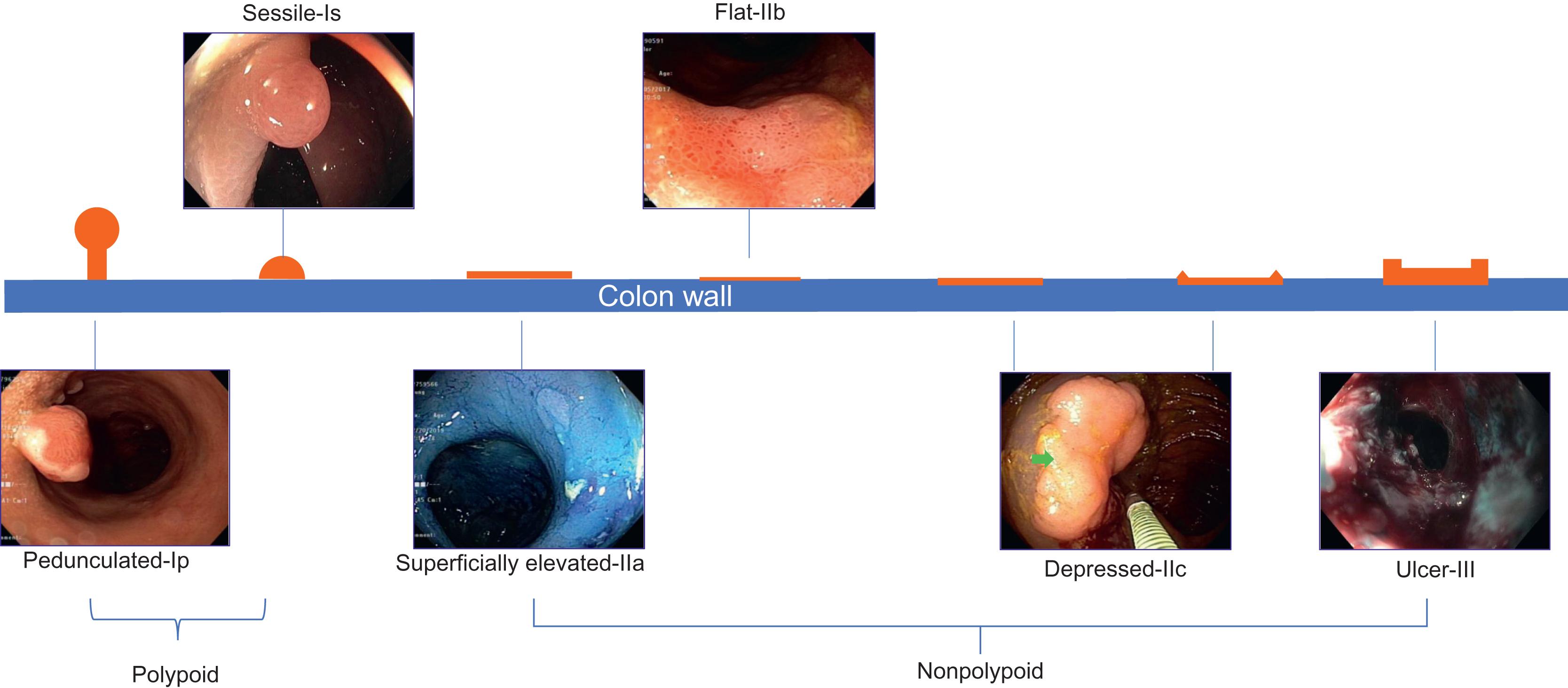 Figure 19.5, Superficial neoplastic lesions in inflammation bowel disease according to the Paris Classification.