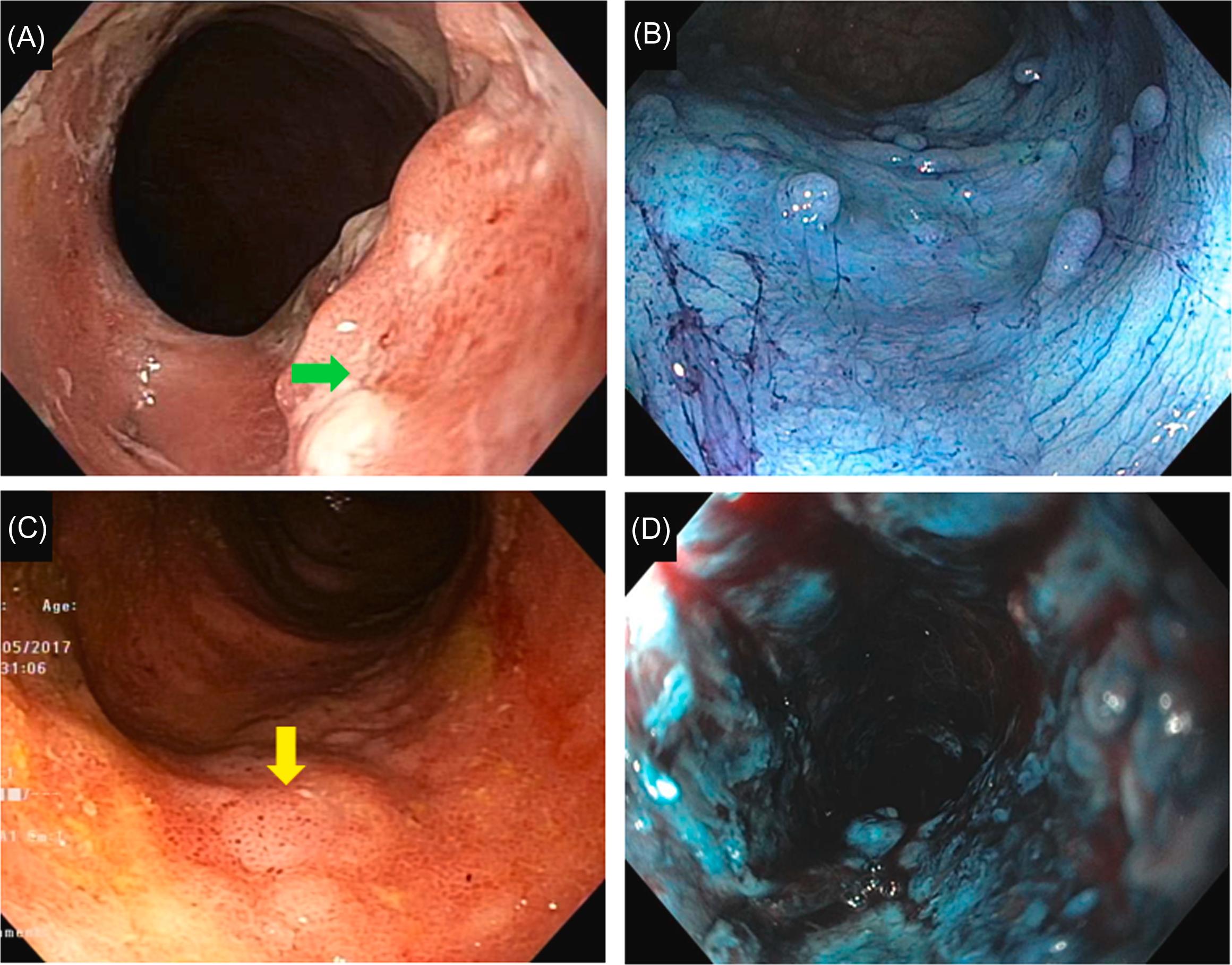 Figure 19.6, Components of the SCENIC Classification: (A) Descriptor- ulceration ( green arrow ), (B) distinct border, (C) indistinct border ( yellow arrow ), and (D) strictured ileal pouch-anal anastomosis with poorly defined surface structure. Histology showed adenocarcinoma (D). SCENIC , the Surveillance for Colorectal Endoscopic Neoplasia Detection and Management in Inflammatory Bowel Disease Patients.