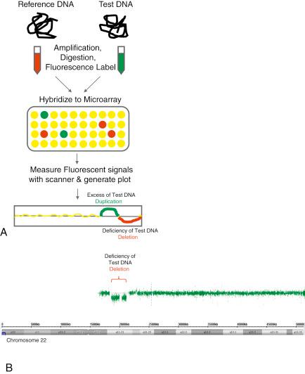 FIG. 12.1, Array comparative genomic hybridization process (aCGH)—Part A shows the aCGH process, which results in determination of the ratio of reference to test DNA at each oligonucleotide on the array. This ratio shows when there is an excess or deficiency of test DNA and is used to identify imbalances such as whole chromosome aneuploidy or microdeletions or duplications. Red signifies a loss of test DNA, and green signifies a gain of test DNA. Part B shows the actual generated image of the copy number plot from an aCGH platform on a case with approximately a 3-MB deletion of 22q11.2.