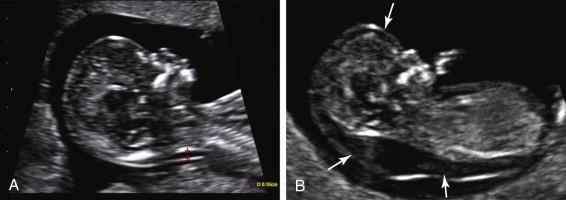 F igure 22-1, Nuchal translucency. A, Normal. Sagittal image of the head and neck demonstrates the normal nuchal translucency as a thin anechoic space (red calipers) measuring 1.6 mm along the posterior aspect of the fetal neck. B, Abnormal. Sagittal image of an embryo with trisomy 21 shows marked thickening of the nuchal translucency that extends along the full length of the embryo and around the head (arrows) .