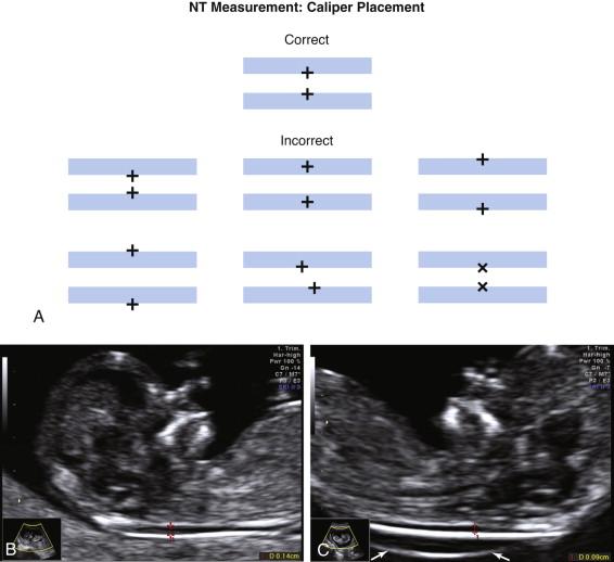 F igure 22-2, A, Nuchal translucency. Schematic representation of correct (top diagram) and various incorrect (middle and bottom diagrams) caliper placements for measuring nuchal translucency (NT). The top diagram showing correct caliper placement illustrates the NT measurement is obtained using calipers with a “+” configuration (not other characters such as “x”). The calipers should be positioned immediately across from each other, perpendicular to the long axis of the nuchal translucency. The horizontal component of the caliper should be positioned along the inner margin of the lines bordering the nuchal translucency, without extending into the nuchal translucency. B, Ultrasound appearance. Image obtained for nuchal translucency measurement depicts features needed for accurate measurement including: Fetal neck in neutral position. The head, neck, and upper thorax of the fetus fill the majority of the image. Sharply marginated echogenic lines surround the nuchal translucency. Measurement calipers are + shaped and positioned along the inner margin of the lines bordering the widest component of the nuchal translucency (red calipers) . C, Amnion. Midline sagittal image demonstrates the amnion (short arrows) separate from the nuchal translucency (red calipers) . Identification of the amnion is important to ensure it is not mistaken for the outer border of the nuchal translucency.