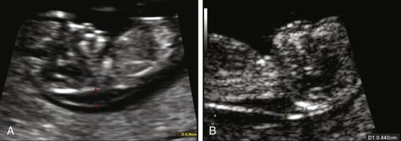 F igure 22-3, Thick nuchal translucency. Midline sagittal images of two fetuses with thick nuchal translucency (3.6 mm in image A and 4.4 mm in image B ). Results of chorionic villus sampling were trisomy 21 (embryo in image A ) and trisomy 13 (embryo in image B ). Additional testing is frequently offered without waiting for results of biochemical screening when the nuchal translucency measures 3 mm or more.