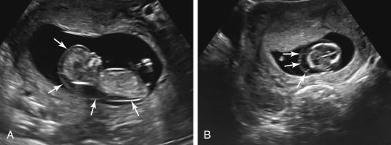 F igure 22-4, Cystic hygroma. A, Midline sagittal image shows a very thick nuchal translucency extending along the entire length of the fetus (arrows) . B, Axial image of the fetal head depicts septations (arrows) in the thick nuchal translucency consistent with cystic hygroma.