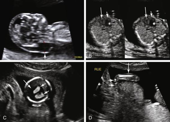 F igure 22-5, A, Thick nuchal translucency: normal karyotype. Midline sagittal image shows thick nuchal translucency of 5.6 mm (arrow) . Thick nuchal translucency with normal karyotype is associated with an increased incidence of structural anomalies (most commonly cardiac) and syndromes. B to D , Images of the same fetus later in pregnancy reveal multiple structural anomalies including: B, Hypoplastic right heart ( long white arrow, right ventricle; short white arrow, left ventricle). In addition, there is an echogenic intracardiac focus (EIF, black arrow ), confirmed by demonstrating presence of the EIF with harmonics (right image) and without harmonics (left image). C, Holoprosencephaly with monoventricle (long arrow), containing bilateral choroid plexus (short arrows) . D, Fixed flexion of the wrist ( long arrow, forearm; short arrows, hand).