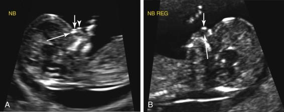 F igure 22-6, Nasal bone visualization during the first trimester. A, Nasal bone visualized: midline sagittal image demonstrates the nasal bone as an echogenic line (long arrow) immediately deep and parallel to the linear echo from the skin surface (short arrow). The tip of the nose is also seen (arrowhead). B, Nasal bone not visualized: midline sagittal image depicts the skin surface as a linear echo (short arrow) . There is no evidence of a second echogenic line deep to the skin surface in the expected location of the nasal bone (long arrow) . NB REG, Nasal bone region.