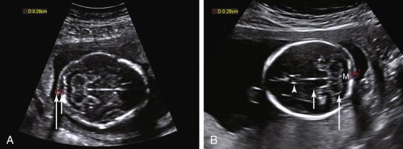 F igure 22-7, Nuchal fold measurement: normal. A, Caliper placement. Axial image of the fetal head shows red calipers positioned along the posterior surface of the occiput (short arrow) and the outer skin surface (long arrow) to measure the nuchal fold. The measurement of 0.29 cm is normal. The nuchal fold is measured from approximately 15 to 20 weeks of gestation and is generally considered thick when it is 6 mm or greater. B, Scan plane. Axial image of the fetal head shows optimal scan plane for nuchal fold measurement (red calipers) . The measurement of 0.26 cm is normal. Note that the image demonstrates the cavum septi pellucidi (arrowhead) , thalami (short arrow) , cerebellar hemispheres (long arrow) , cisterna magna (M), and occipital bone.