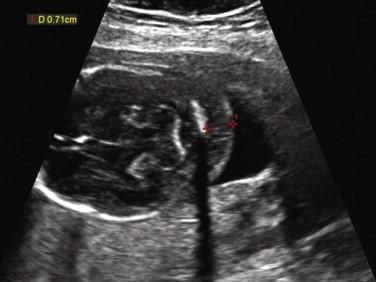 F igure 22-8, Thick nuchal fold. Axial image of the fetal head demonstrates a thick nuchal fold (red calipers) measuring 0.71 cm. The fetus was subsequently shown to have Down syndrome.