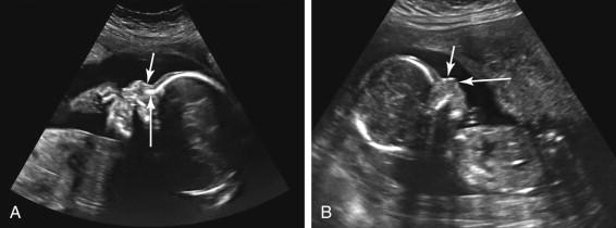 F igure 22-9, Nasal bone visualization during the second trimester. A, Nasal bone visualized: midline sagittal image of a second-trimester fetus depicts the nasal bone as an echogenic line (long arrow) deep to the skin surface (short arrow) in the nose region. B, Nonvisualized nasal bone: midline sagittal image of a second-trimester fetus with Down syndrome demonstrates nonvisualization of the nasal bone in the expected location (long arrow) deep to the skin surface (short arrow) in the nose region.