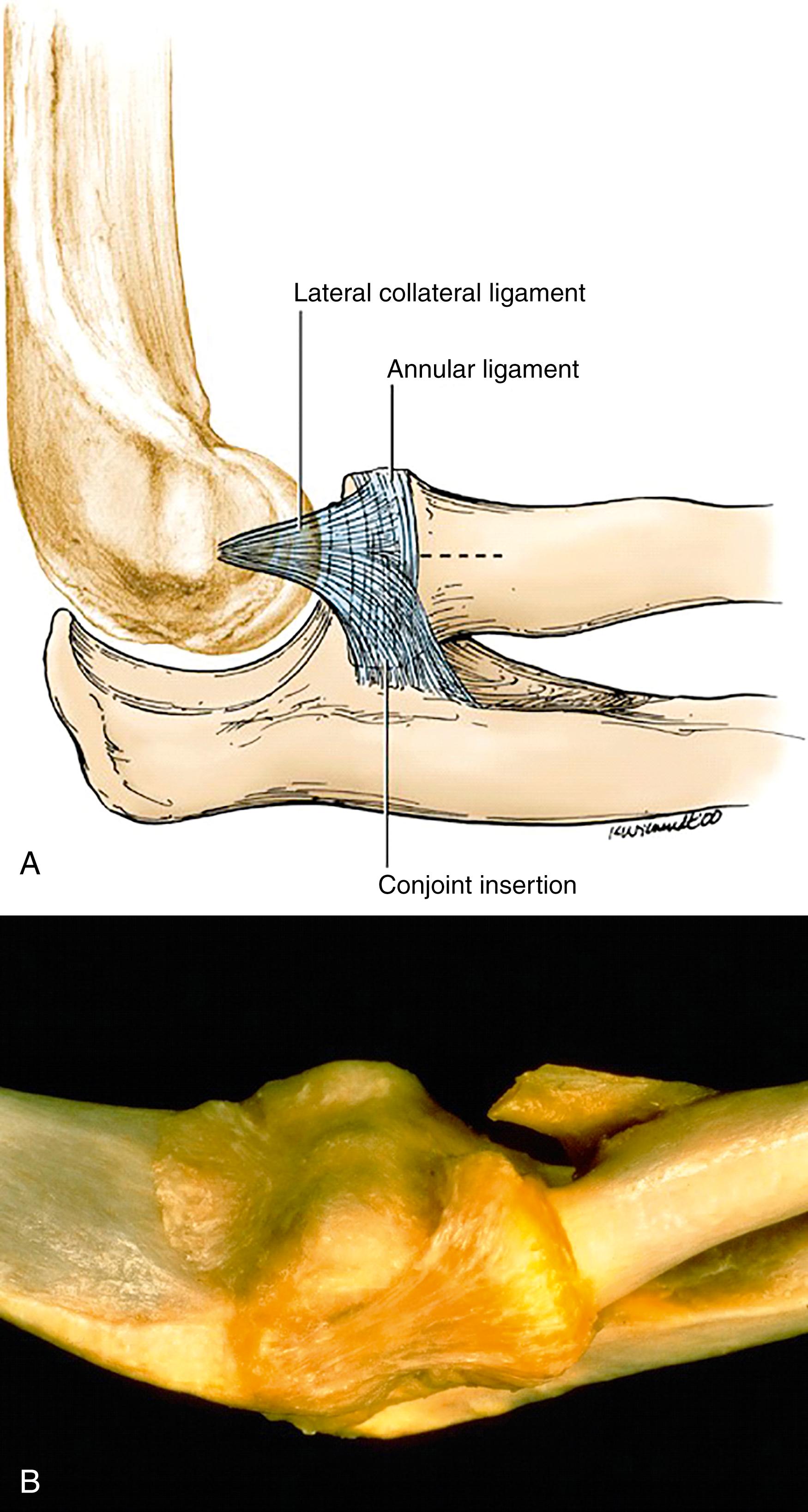 Fig. 23.1, Schematic drawing (A) and cadaveric specimen (B) depicting anatomy of the lateral collateral and annular ligament complex. The overlying extensor muscles and supinator fibers have been removed. The collateral ligament originates at the base of the lateral epicondyle and fans out, blending with the annular ligament anteriorly. The posterior band of the lateral collateral, also known as the lateral ulnar collateral ligament, forms a broad insertion onto the proximal ulna along the supinator crest just posterior and distal to the radioulnar joint.