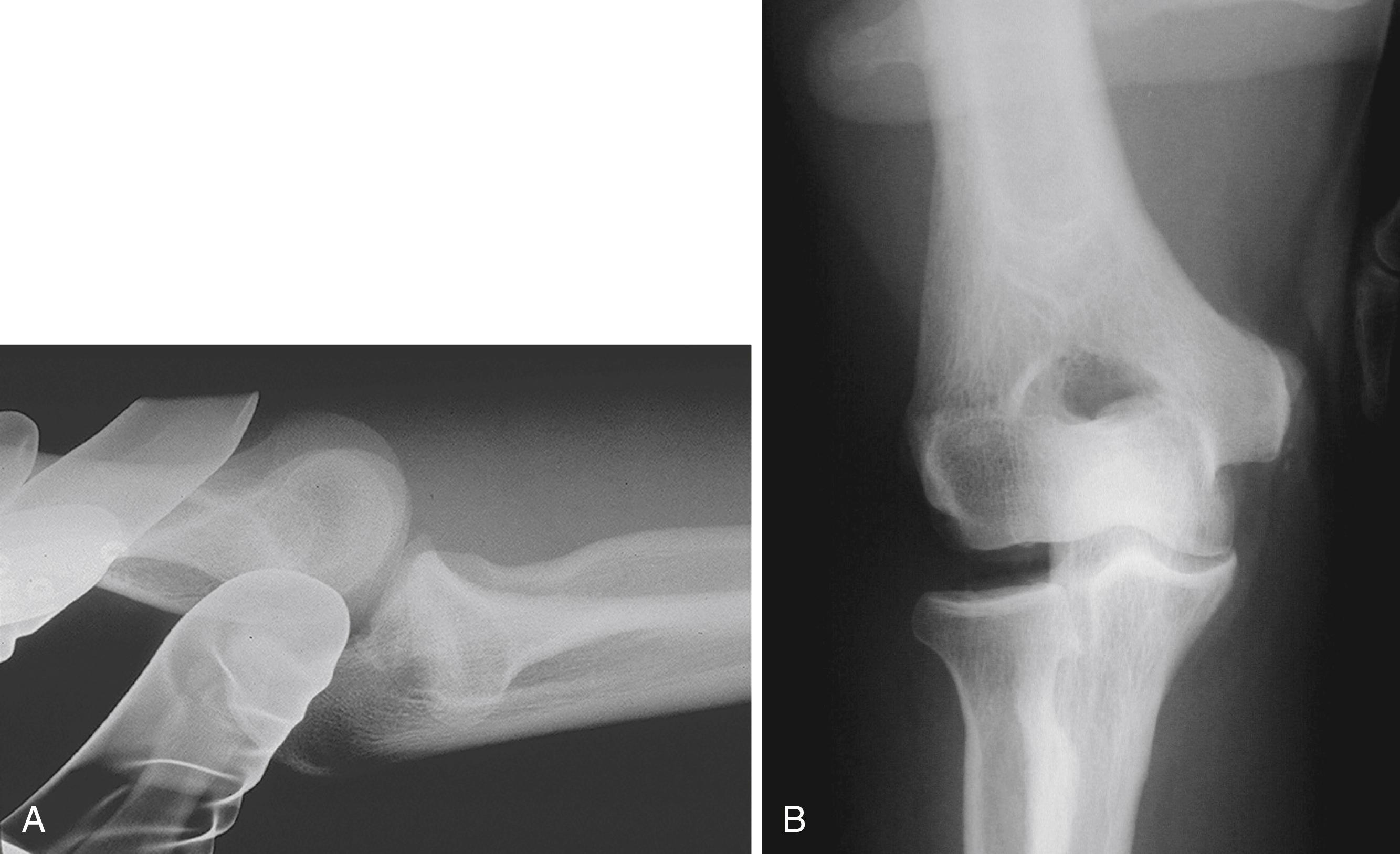 Fig. 23.2, A, Lateral stress radiograph taken in a patient with lateral collateral instability of the elbow. This is taken with provocative stress applied using the rotatory instability test (supination with axial and valgus force applied). Note the gapping at the ulnohumeral articulation and posterior translation of the radial head now projecting posterior to the center of the capitellum. B, Anteroposterior stress radiograph in a patient with lateral collateral instability of the elbow. This is taken with varus stress applied to the joint. Note the gross gapping of the lateral joint between the radial head and the capitellum, confirming the diagnosis.