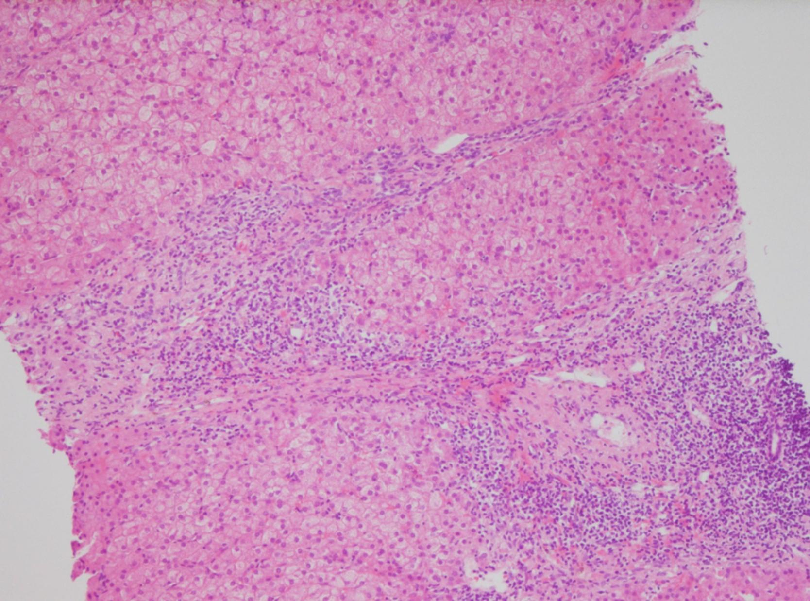 Fig. 44.3, Patient 1: Protocol biopsy 5 years after pediatric liver transplantation (hematoxylin and eosin [HE] staining, 100 × magnification) showing portal inflammation and periportal fibrosis (liver allograft fibrosis score, 3/9) with interface activity.