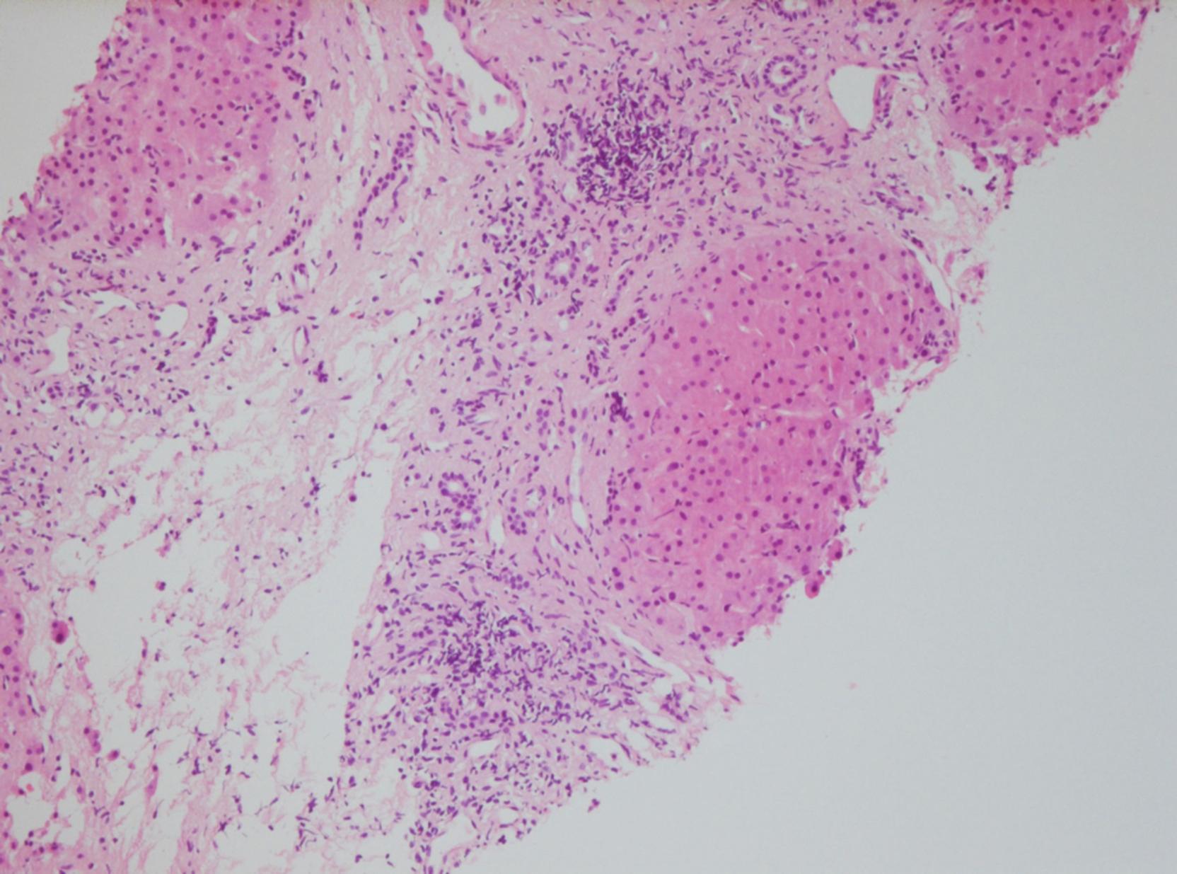 Fig. 44.5, Patient 2: Protocol biopsy 6 years after pediatric liver transplantation (hematoxylin and eosin staining, 100 × magnification) showing advanced periportal fibrosis (liver allograft fibrosis score, 5/9) and mild to moderate portal inflammation.
