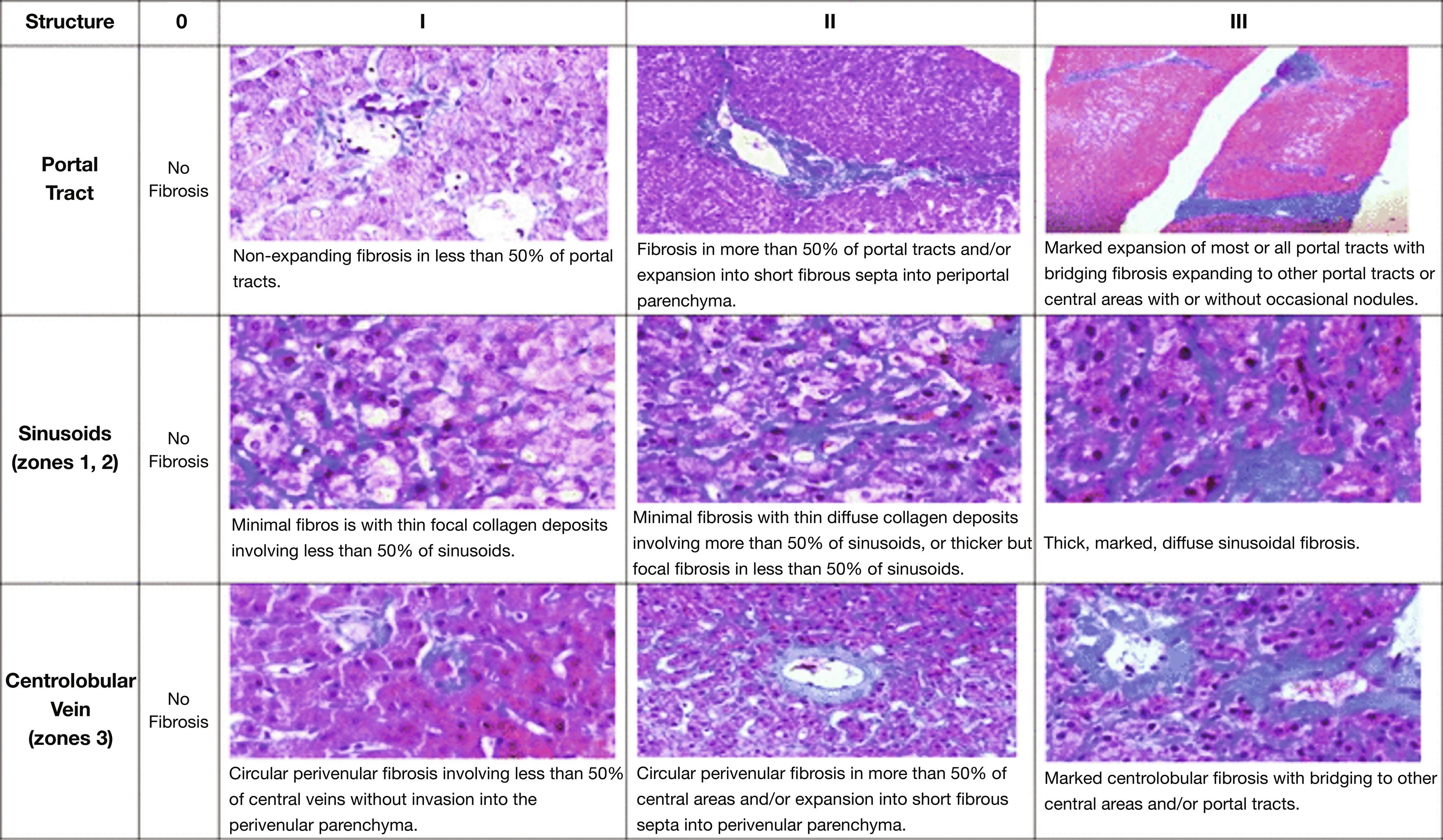 Fig. 44.2, Liver allograft semiquantitative scoring system (Venturi score) for assessment of fibrosis in pediatric liver transplant biopsies: histologic features and staging definitions.